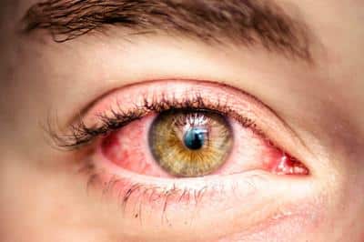 Jedna od najpoznatijih nuspojava koje uzrokuje THC su crvene oči.