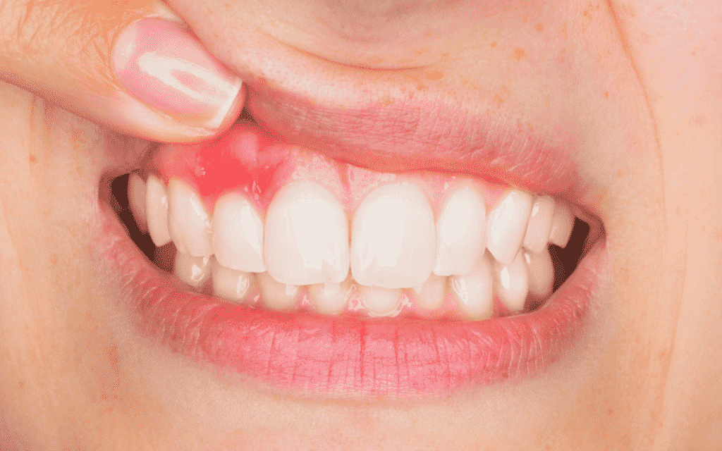 Otkriveno je da česta konzumacija kanabisa dovodi do lošijeg dentalnog zdravlja.